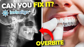 Can Invisalign FIX an Overbite Orthodontist Explains [upl. by Dalia444]