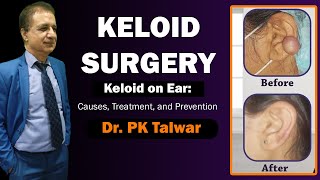 Keloid Surgery in Delhi Keloid on Ear Piercing Causes Prevention and Treatment by Dr PK Talwar [upl. by Eniger]