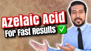 Azelaic Acid for Melasma  How to Use Azelaic Acid for SUCCESS 🏆 [upl. by Godrich348]