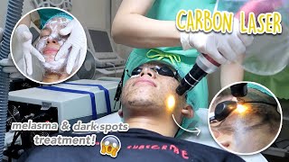 FIRST Carbon Laser Treatment for Melasma Dark Spots amp Hyperpigmentation Philippines [upl. by Alexandria513]