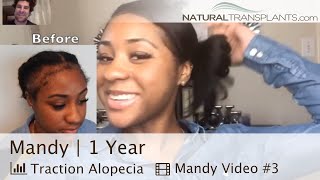 Traction Alopecia Regrowth 2021  I Got My Edges Back After Traction Alopecia Mandy [upl. by Emlen]