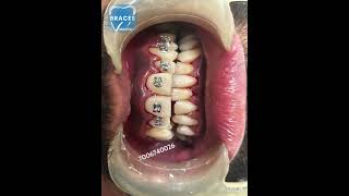 Class 2 div 1 Malocclusion  BRACES trending dentist toothdental dentalcare dentalclinic tooth [upl. by Elburr429]