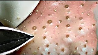 Best Satisfying Nose Plucking Blackheads Whiteheads Removal  Acne Treatment 19 [upl. by Yoj732]