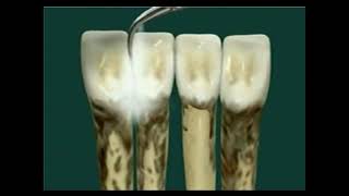 Periodontitis concepto definicion proceso como ocurre y tratamiento [upl. by Uda]