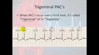 Basic Electrophysiology part 7  Atrial Rhythms part 1 Introduction and PACs [upl. by Alomeda]