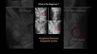 Scaphoid fracture  Scaphoid series 141Trauma Xray  Upper limb gallery 2radiologychannel007 [upl. by Knobloch]