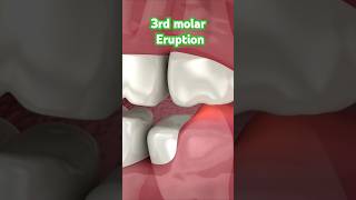 Pain in 3rd molar region dentist dentalhealth teeth dentalcare trending youtubeshorts viral [upl. by Gustafsson760]