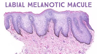 Labial melanotic macule brown spot on lip Stony Brook Case 1 dermatology dermatopathology [upl. by Atwekk191]