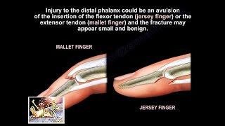 Mallet and Jersey Fingers Description Everything You Need To Know  Dr Nabil Ebraheim [upl. by Rambert]