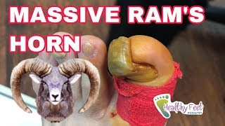 MASSIVE RAMS HORN NAIL REMOVED UNBELIEVABLE BIG THICK TOENAIL [upl. by Niarda369]