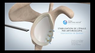 STABILISATION DE LÉPAULE PAR ARTHROSCOPIE INTERVENTION DE BANKART  DR MATTHIEU MEYER [upl. by Teeter]