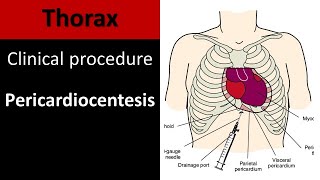 Pericardiocentesis I Anatomy of clinical procedure pulmonaryresidentessential6481 [upl. by Nivlek]