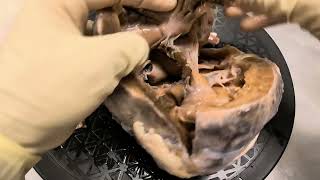 Specimen walkthrough 13 Double inlet double outlet right ventricle Cardiac anatomy pathology [upl. by Eledoya523]