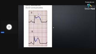 EKG fácil y rápido  Clase 7 Casos clínicos [upl. by Enilreug393]