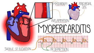 Myocarditis amp Pericarditis Myopericarditis Explained [upl. by Annaoj]