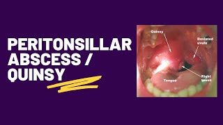 Peritonsillar abscess  Quinsy [upl. by Hill590]