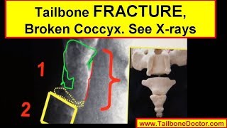 Xrays showing COCCYX FRACTURE broken tailbone [upl. by Hunfredo548]