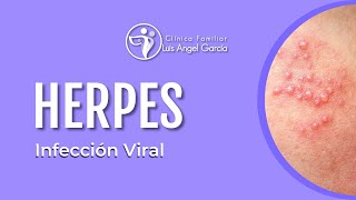 Herpes  Infección Viral [upl. by Neladgam]