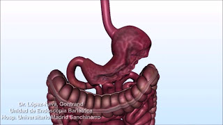 Técnica endoscópica de cirugía bariátrica Método Apollo [upl. by Sheley]