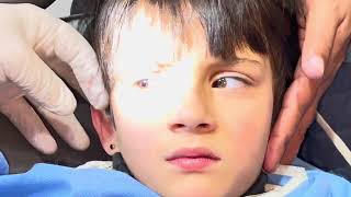 Split Pencil Graphite Safely Extracted from Child’s Ear [upl. by Irelav]