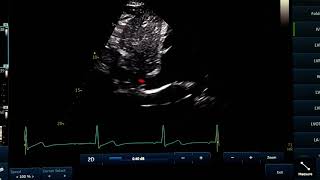 IVC view and measurment [upl. by Nicolais104]