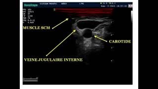 ABORD VEINEUX CENTRAL SOUS ECHOGUIDAGE PAR LE DR BOUARROUDJ NOREDDINE [upl. by Golanka171]