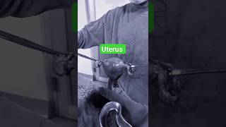 uterus fibroiduterus uterustransplant retroverteduterus shortsfeed shortvideo [upl. by Yrrehc]