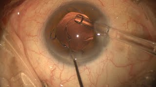 Cataract Surgery with Capsular Tension Ring amp Malyugin ring after blunt trauma causing iridodialysis [upl. by Ecnerat]