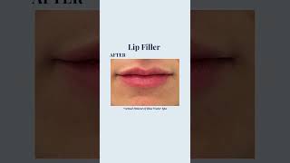 Lip Filler Injections  Before and After Lip Augmentation [upl. by Grube]