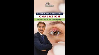 आँख की पलक में गाँठ Chalazion का कारण और उपचार  Dr Deepak Vaidya  Eye Surgeon [upl. by Hsiwhem]