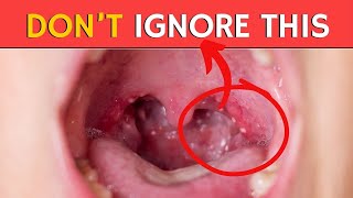 Tonsil Stones – Removing the Deeper Cause [upl. by Edny]