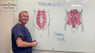 Drainless tummy tuck with explanation of how it is done by Dr Claytor [upl. by Jenelle923]