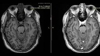 case 19 52 year male from ICU subacute infarct mimic neoplasm [upl. by Ahtnama]