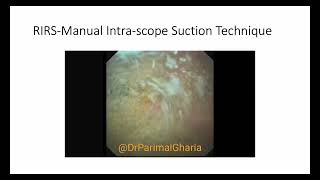 RIRSManual Intrascope Suction Technique [upl. by Hgielsel]