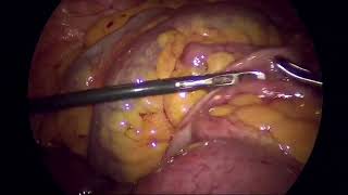 Laparoscopic management of Adhesive Band small bowel obstruction [upl. by Qidas384]