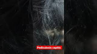 Pediculosis extreme  very severe head lice infestation shorts [upl. by Enelyk]