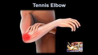 Tennis Elbow why it hurts Everything You Need To Know  Dr Nabil Ebraheim [upl. by Ayaet]