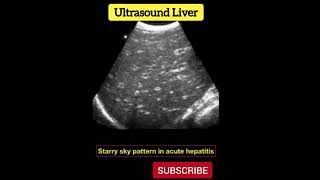 Diagnosis  Ultrasound Liver  Practical case  Radiology [upl. by Peltz]