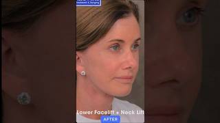 Lower Facelift Surgery Before and After  Facelift Surgery  Mini Facelift Before After  Neck Lift [upl. by Jenks]