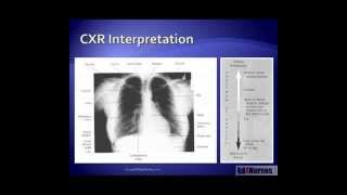 5 Steps to Chest Xray Interpretation [upl. by Nwahsav]