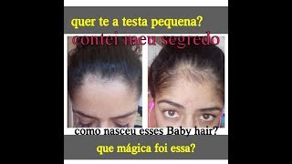 Minoxidil 3 meses ANTES E DEPOIS Funciona mesmo [upl. by Lek]