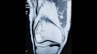 Right chondromyxoid fibroma femur [upl. by Penelope]