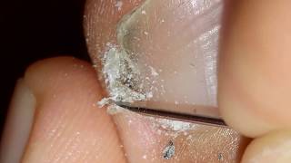 How to clean in depth lateral toenail fold 10 [upl. by Miza684]