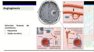 Parte 1 Gliomas de alto grado Astrocitomas de alto grado [upl. by Aerdnaeel977]