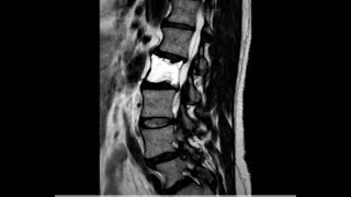 rare case of hemangioma L2 L3 [upl. by Weinshienk]