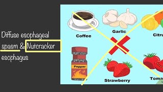 Diffuse esophageal spasm amp Nutcracker esophagus signs amp symptoms with diagnosis amp treatment [upl. by Memory]