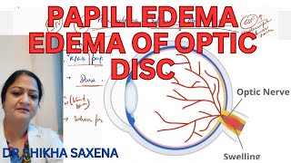 Papilliedema Edema of optic disc high CSF Pressure [upl. by Shara625]