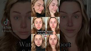 Watch my lip filler amp Dysport set in  daily progress [upl. by Notkcorb]