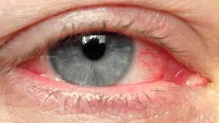 Eye cancer symptoms [upl. by Efram]