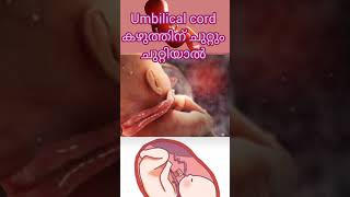 Cord around neck malayalam pregnancycomplication baby deliverylife umbilical umbilicalcord [upl. by Ihp421]